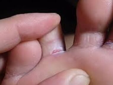 I have toe fungus