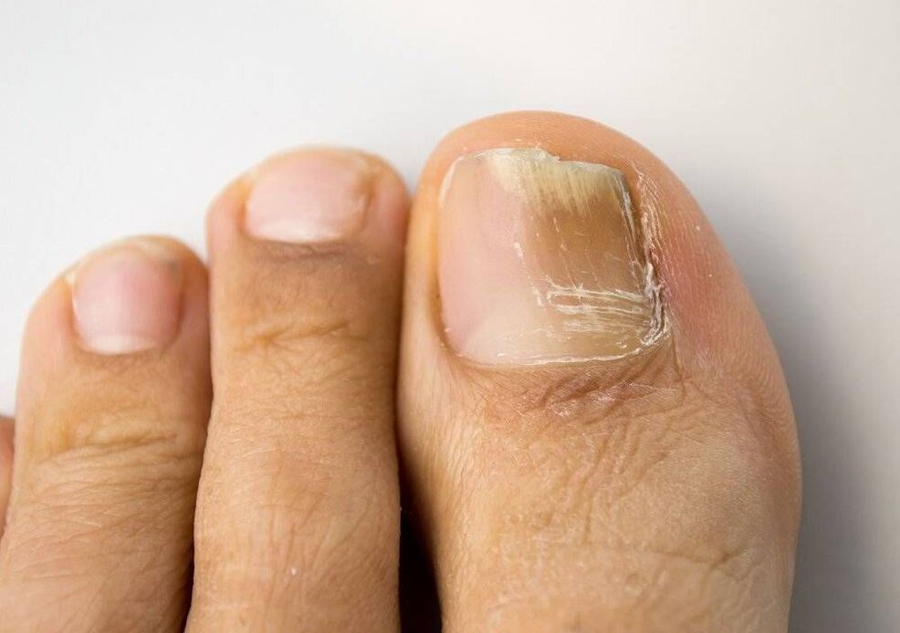 Types of fungal infections on the big toe