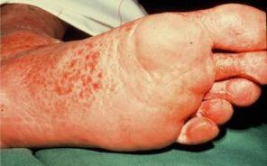 Mushroom on the foot with ulcers