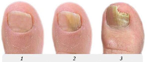 The process of developing the mushroom on the thumb