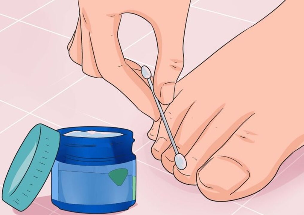 Heal nail fungus