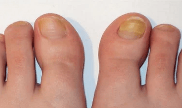 The initial phase of the nail fungus