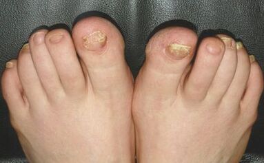 Signs of mushrooms on the nails