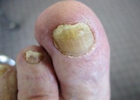 The causes of the appearance of the mushroom on the nails