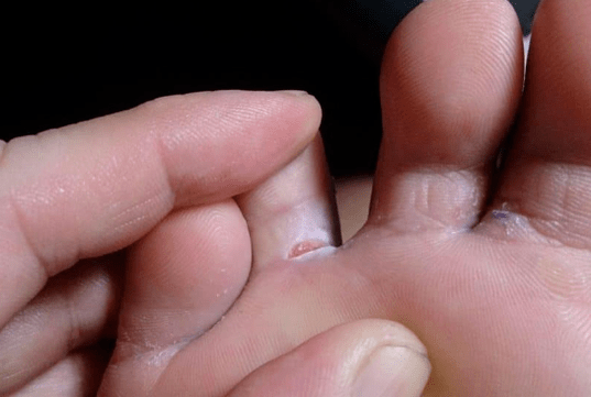 The appearance of bladder formations on the feet