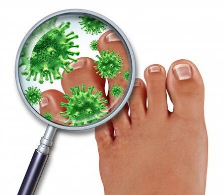 Fungal infection on the feet