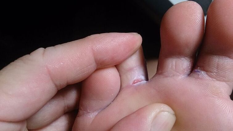 Athlete's foot