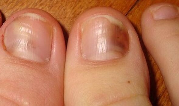Nails affected by fungus