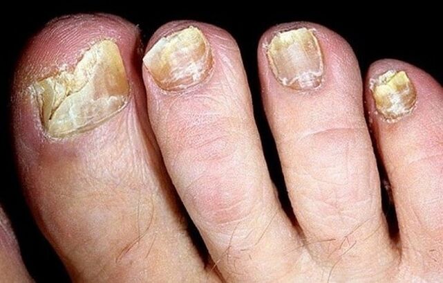 Fungus on toenails
