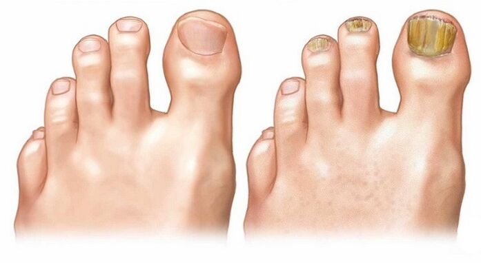 healthy nails and toenail fungus