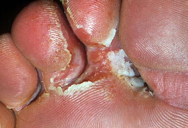Symptoms of an interdigital fungus