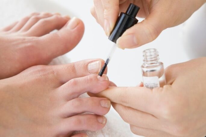 Regular use of medicinal varnish will speed up the treatment of onychomycosis