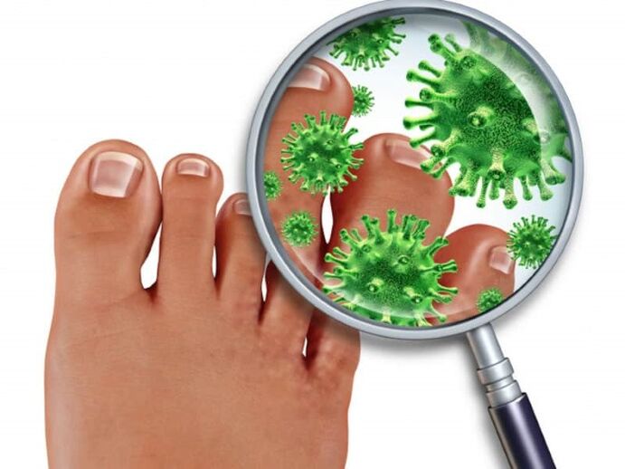 Toenail fungus affects immunocompromised people