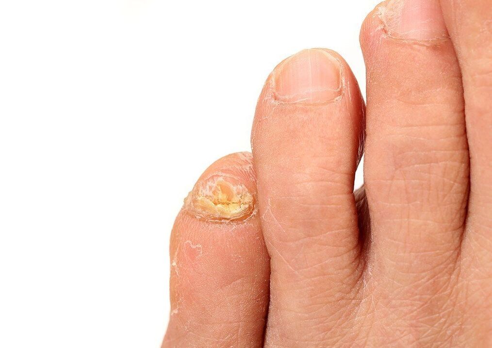 Fungus on toenails