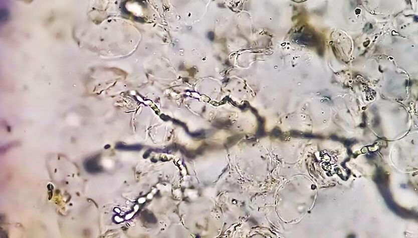 Fungi under the microscope - the cause of mycoses on the feet