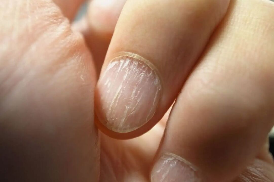 Hapalochnia on the nails