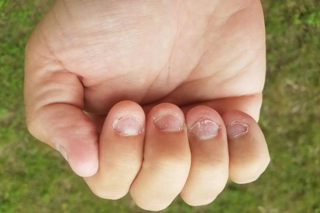 Micronychia on the nails