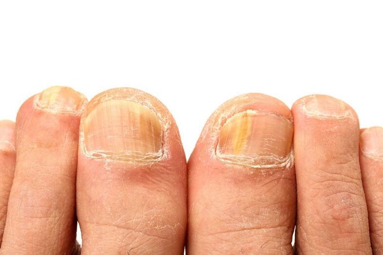 Onychomycosis of the nails