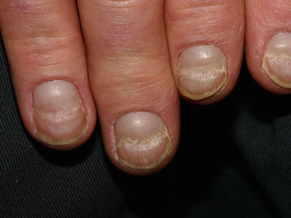 Onychoschisis of the nail plate