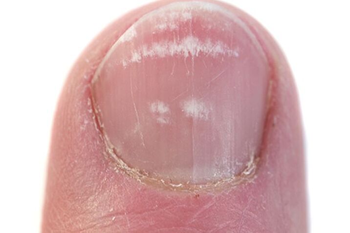 Signs of nail fungus